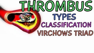 What is a Thrombus Types  Classification  Virchows Triad [upl. by Ardiek568]