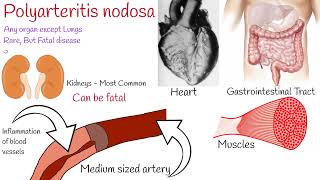 Polyarteritis nodosa  symptoms and treatment [upl. by Larine776]