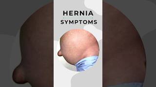 Hernia symptoms I Problems due to Hernia 7428617074 [upl. by Baxy225]