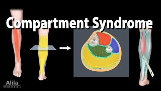 Compartment Syndrome Animation [upl. by Lynden]