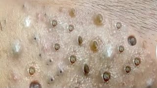 Big Cystic Acne Blackheads Extraction Blackheads amp Milia Whiteheads Removal Pimple Popping  8371 [upl. by Htebaile]