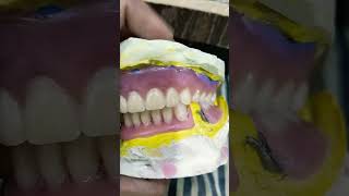 Upper Lower Removable Denture Ready For Flasking completedenture rpddentalprocedure [upl. by Azile713]