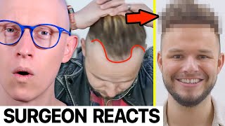 REMARKABLE 6 Months Hair Transplant Before amp After  Surgeon Reacts [upl. by Siravat]