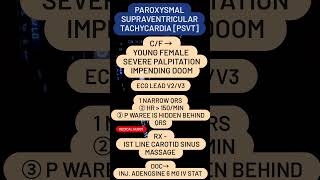 PAROXYSMAL SUPRAVENTRICULAR TACHYCARDIA PSVT [upl. by Anyale]