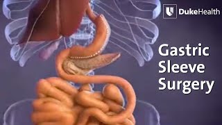 Gastric Sleeve Surgery  Duke Health [upl. by Yuri820]