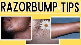 How to Get rid of Razor Bumps Ingrown hairs [upl. by Freeborn]