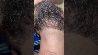 Ingrown hairs satisfying ingrownhairremoval barber removingingrown hair hairproblem [upl. by Ahsener]