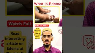 Edema क्या होता है  इसके Types क्या होते है  edema swelling shortsfeed [upl. by Francesca]