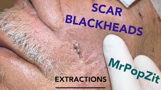 Giant blackheads imbedded in scar tissue extracted Common occurrence with surgical procedures [upl. by Wallford918]