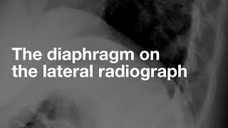 The Diaphragm on the Lateral CXR [upl. by Nneb]