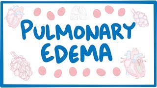 Pulmonary Edema  causes symptoms diagnosis treatment pathology [upl. by Pate]