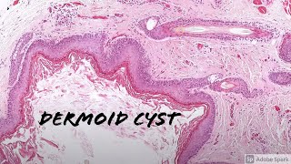 Dermoid Cyst 5Minute Pathology Pearls [upl. by Spurgeon408]