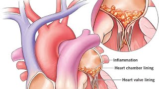 Infective Endocarditis [upl. by Aihpledalihp]