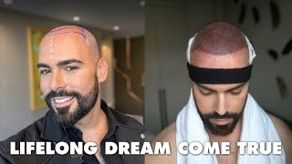 My Emotional Hair Transplant Journey in Istanbul Turkey with Hairneva [upl. by Sampson235]