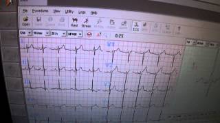 Jaeger Master Screen CPX  Module ECG [upl. by Ayt]