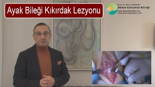 Ayak Bileği Kıkırdak Lezyonu [upl. by Tooley]