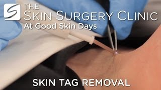 Skin Tag Removal  Watch the Procedure [upl. by Haliled212]