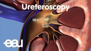 Removal of kidney stones URS [upl. by Gerrald342]