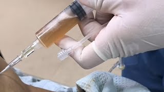 Como Hacer Una PARACENTESIS Abdominal  Prácticas De Enfermería  enfermeria viralvideo [upl. by Dam]