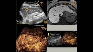 Simple liver cyst located in the left lobe [upl. by Notreve]