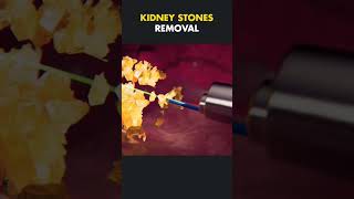 Kidney stone removal surgerypercutaneous nephrolithotomy PCNL [upl. by Stanton]