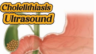 How to scan Gallstones  Cholelithiasis  calcified wall  cholecystitis  Sludge  Liver Ultrasound [upl. by Okuy251]