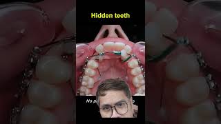 HIDDEN TEETH remix remixshorts teeth tooth dental teethbraces retainer toothcare dentalcare [upl. by Ardnwahs]