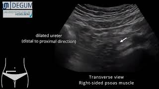 Episode 37 NephroUrolithiasis [upl. by Fanchon]