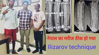 नेपाल का मरीज सही हो गया  infection in tibia bone fracture treatment with Ilizarov technique [upl. by Leiruh]