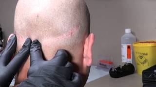 Micro Hair Pigmentation MHP van FUT litteken bij Beauty Care Nederland BCN te Katwijk [upl. by Etteuqaj779]