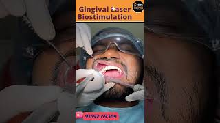 Laser Treatment For Gums Unlocking The Power Of Gingival Laser Biostimulation  shorts [upl. by Granthem]