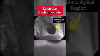 Myocardial Infarction due to Stress Takotsubo cardiomyopathy heart stress shorts shortsvideo [upl. by Durward953]