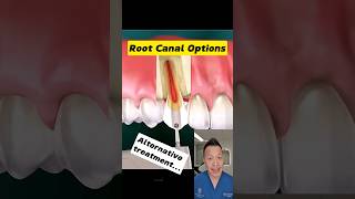 Top 4 Root Canal Alternatives You Should Know dentallan dentist shorts [upl. by Gerti993]