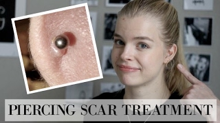 How to treat Hypertrophic ScarsPiercing Bumps [upl. by Ellerrehc]