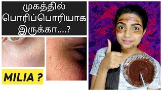 💥💥MILIAவை எப்படி அகற்றுவது  How to treat MILIA AT HOME IN TAMIL [upl. by Schell]