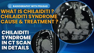 Chilaiditi syndrome in CT scan  Chilaiditi syndrome sign symptoms and treatment  Prasad Layek [upl. by Teodoor900]