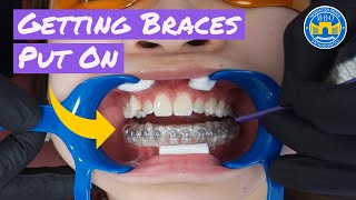 Process of Getting Braces [upl. by Banyaz716]