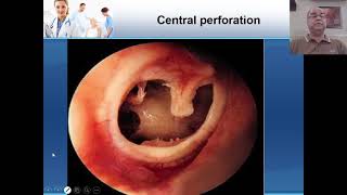 CSOM Tubotympanic Part1 [upl. by Mannie]