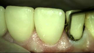 Gingival retraction [upl. by Kisung]