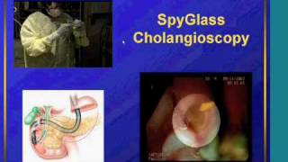 Management of difficult bile duct stones with the Holmium laser through SpyGlass [upl. by Ahsied]