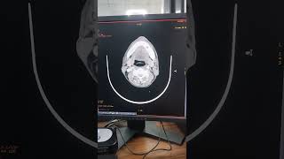 CT SCAN OF BRAIN ANGIOGRAPHYmedical shortfeedsviralmillion 1000subscriberctscan angiography [upl. by Lagasse]