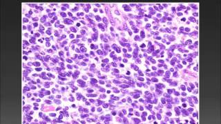 CARCINOMA DE CELULAS MERKEL C C M [upl. by Ahsirt99]