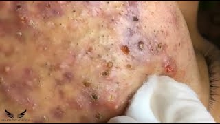 Blackhead Whitehead Removal  Cystic Acne Treatment  Elderly Pimple Popping  Facial Acne Spa 082 [upl. by Iong]