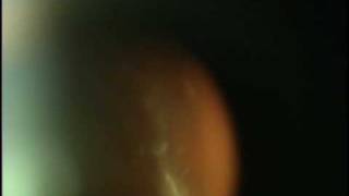 Eye Floaters Scott Geller MD Fort Myers Florida [upl. by Leclair]