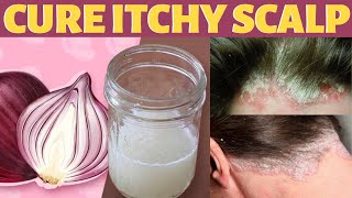 How To Treat Itchy Scalp And Dandruff Naturally At Home Without Washing Your Head [upl. by Geraint]