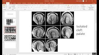 Orthodontics Cleft Lip and Palate Lecture 1 المرحلة الخامسة [upl. by Montana]