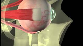 Thyroid eye disease  12 Squint surgery  The operation [upl. by Ardnuhsed796]