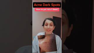 How to Treat Dark Acne Spots Clear Skin Solutions That Work [upl. by Stouffer263]