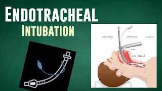 ENDOTRACHEAL INTUBATION  ET Tube Insertion [upl. by Carolynne]