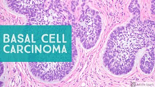 Basal Cell Carcinoma BCC 101  Dermpath Basics Explained by a Dermatopathologist [upl. by Aitnis913]